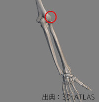 テニス肘（上腕骨外側上顆炎）